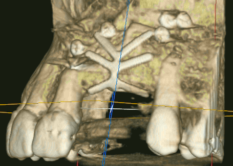 CBCT scan
